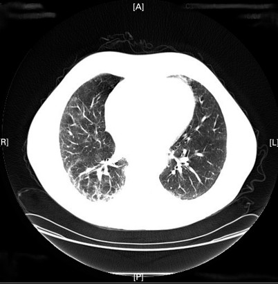 TC axial, campo inferior, antes