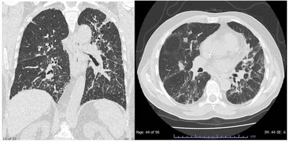 TC coronal y axial de referencia, toxicidad por bleomicina