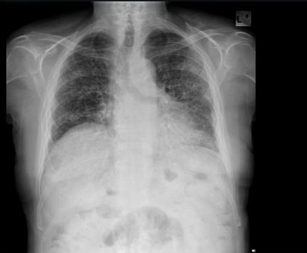 Radiografía PA, opacidades reticulares basales con pérdida de volumen