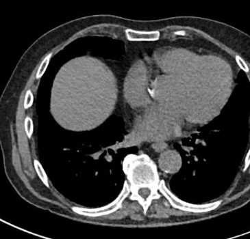 TC axial, ventana mediastínica