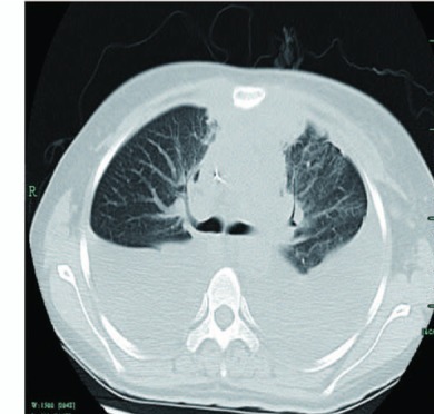 TC axial, día +7, derrame pleural bilateral