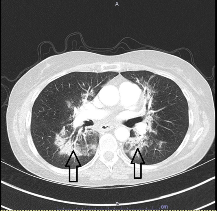 TC axial, opacidades en vidrio deslustrado bibasales, con flechas señalando los hallazgos