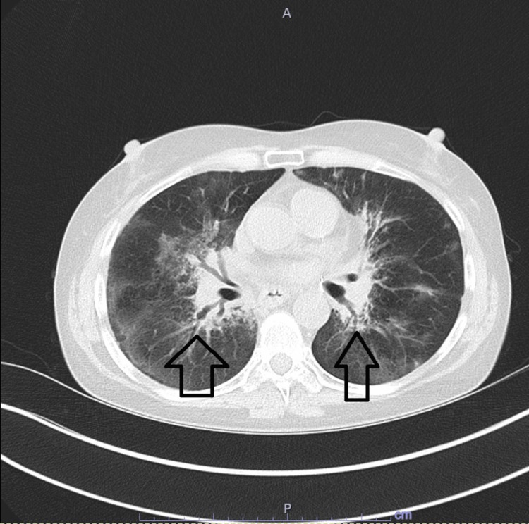 TC axial de control, mejoría parcial tras corticoide